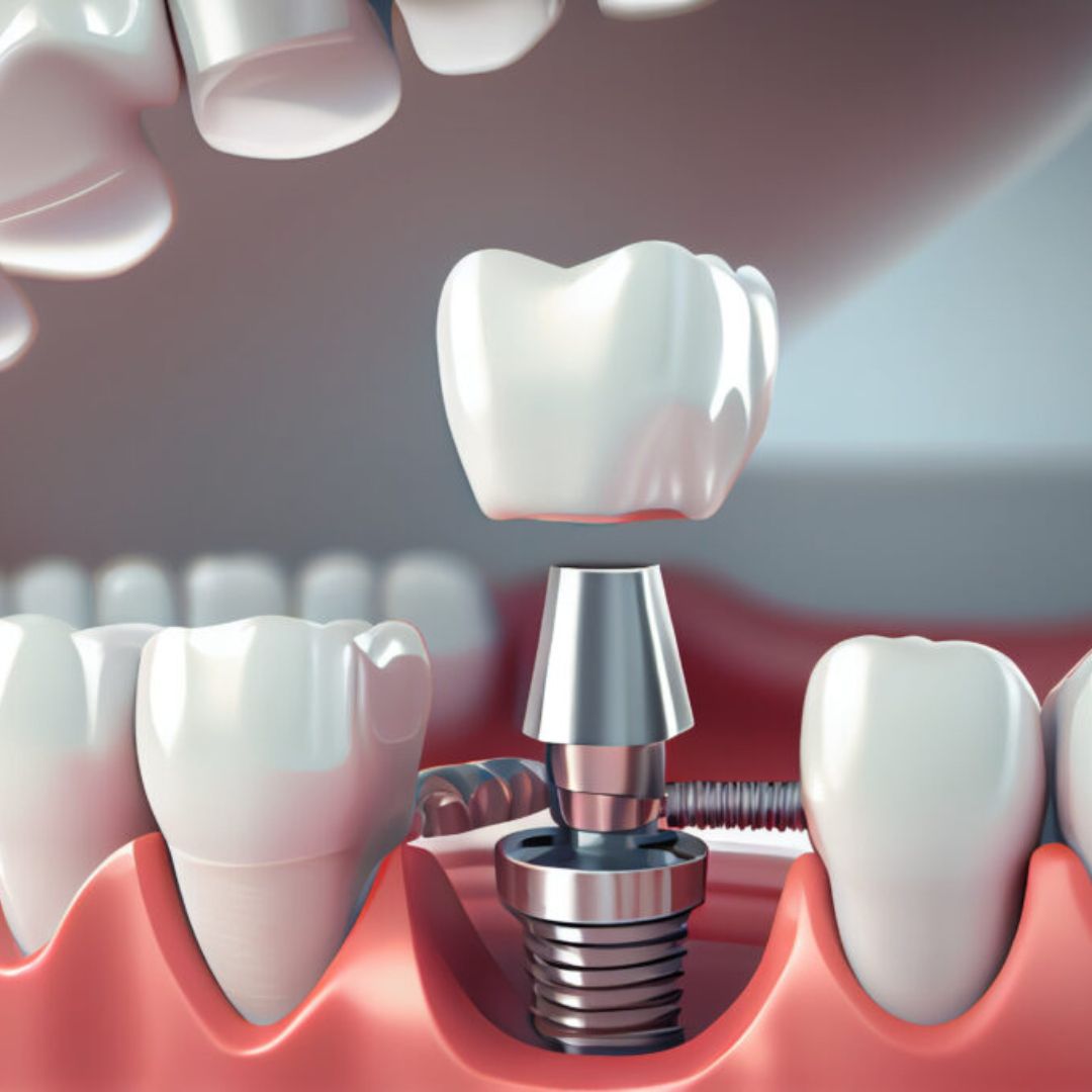 Dental Implants